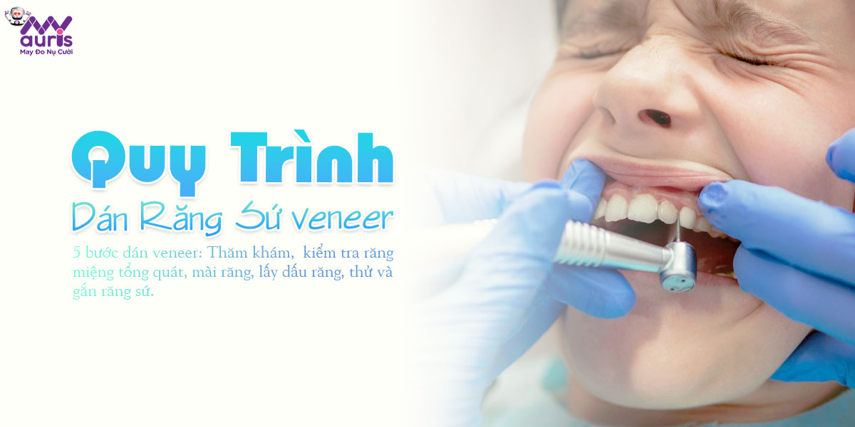 Quy trình dán răng sứ veneer - Nâng tầm nụ cười