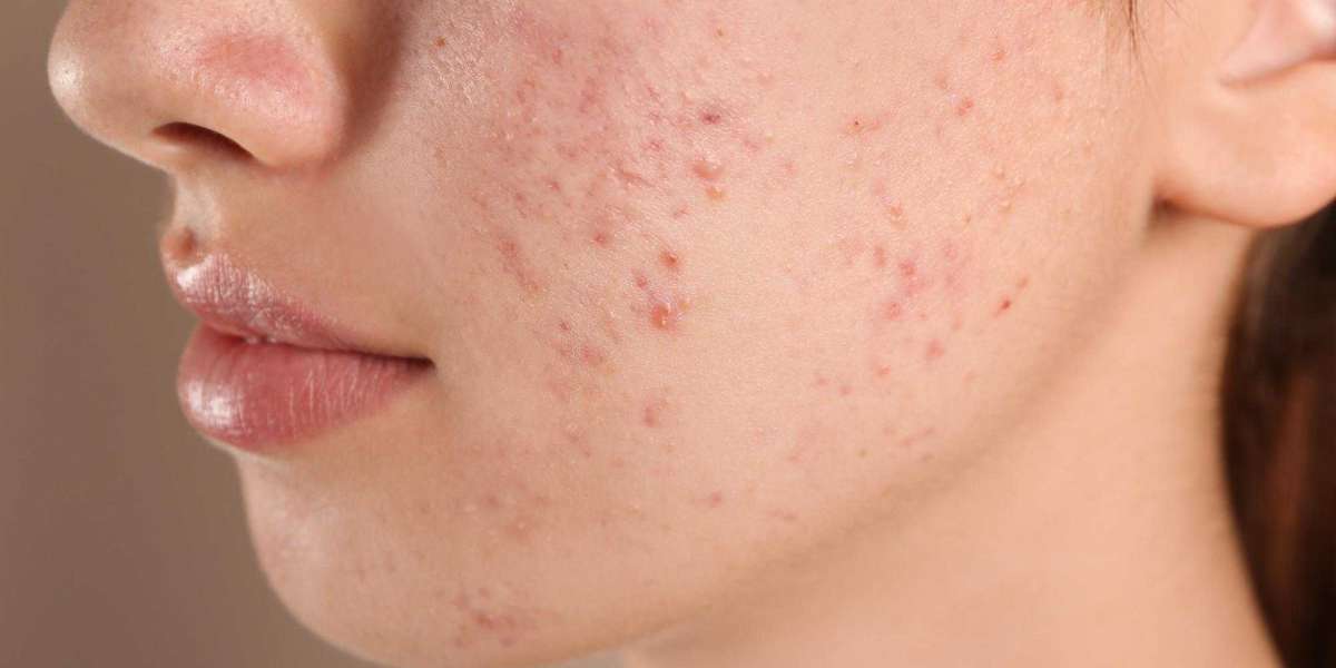 Skincare Routine for Acne-Prone Skin: Do's and Don'ts