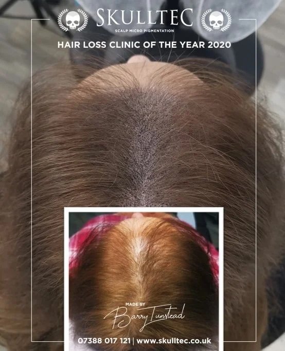 Scalp Micropigmentation for Women | SMP for Women