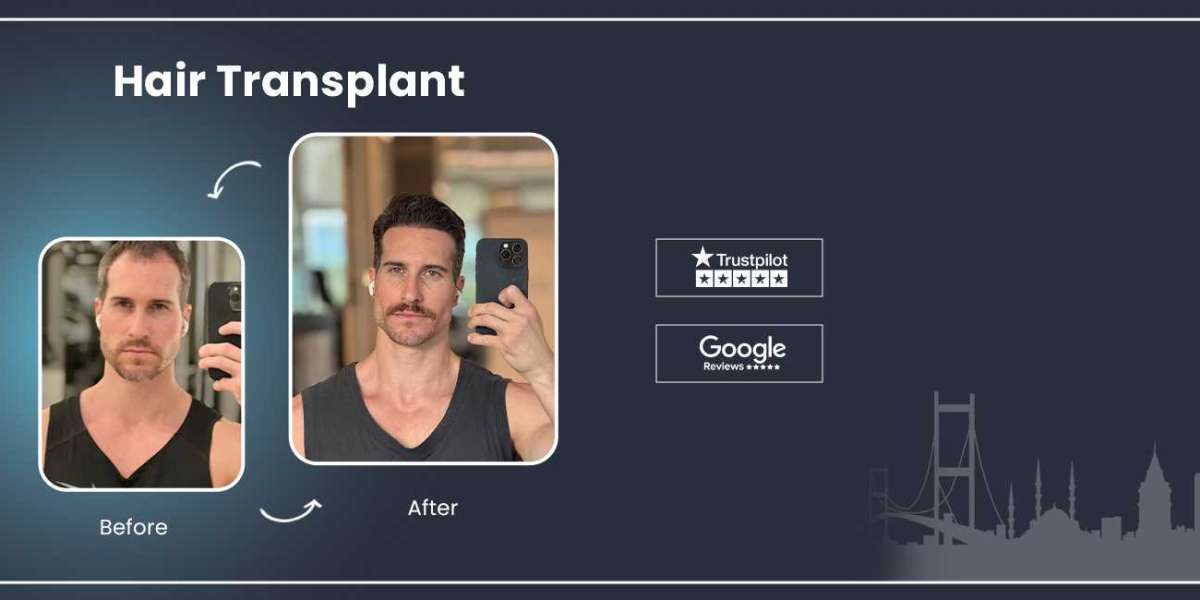 Step-by-Step Journey of a Hair Transplant at Sapphire Hair Clinic